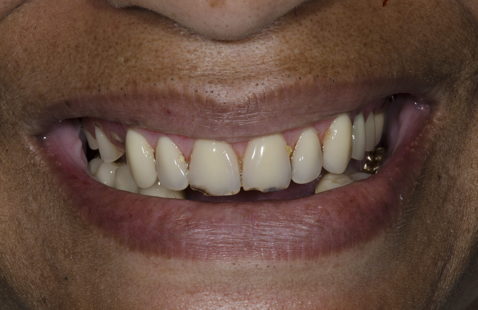 Implant Removable Denture Dr. Rajesh Swamidass