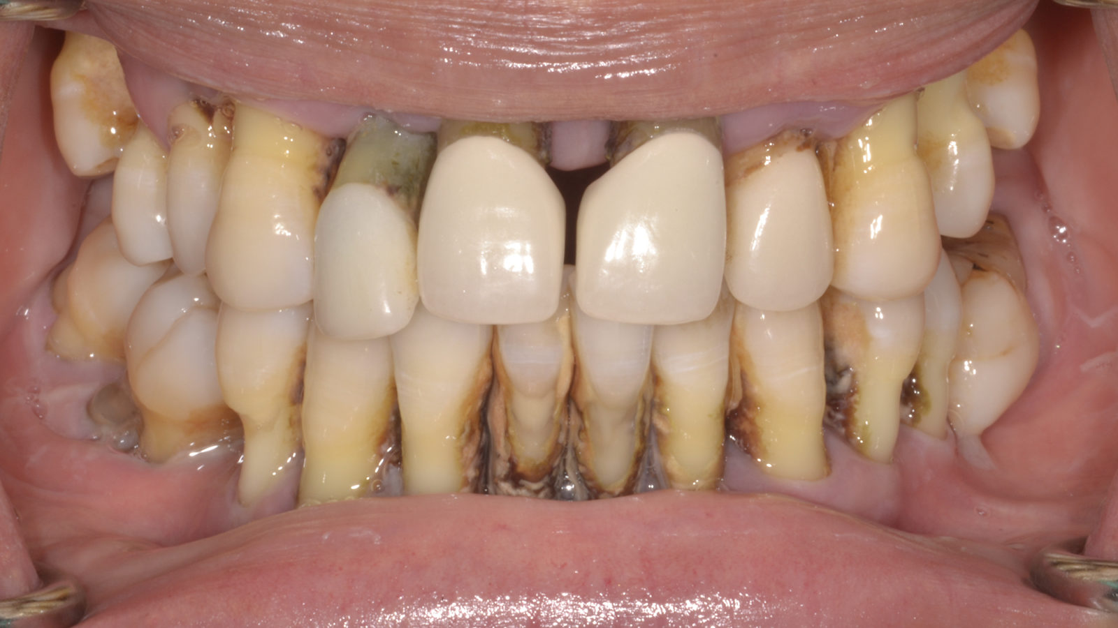 Full Mouth Implants and Zirconia Prosthesis Dr. Rajesh Swamidass